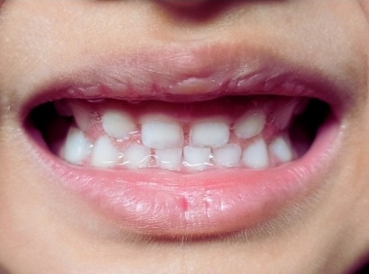 Mondhygiëne voor kinderen: voorbeeld van een gezond kindergebit