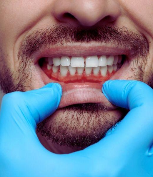 Close-up mondonderzoek tandvlees bij Mondhygiënist Elles in Assen